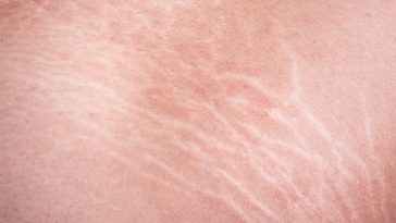 How Do You Get Rid Of Stretch Marks?