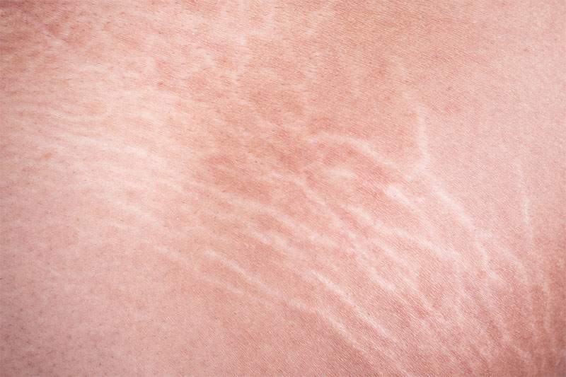 How Do You Get Rid Of Stretch Marks?