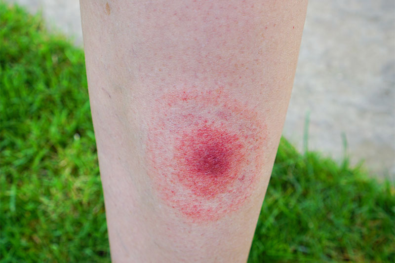 A Circular-Shaped Rash