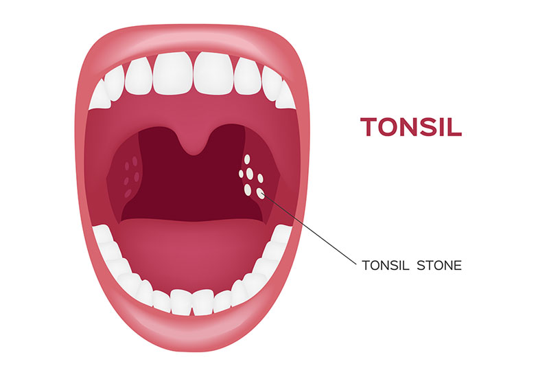 Tonsillitis And Tonsil Stones