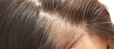 Something That You Eat Could Be To Blame For Thinning Hair