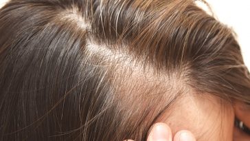 Something That You Eat Could Be To Blame For Thinning Hair