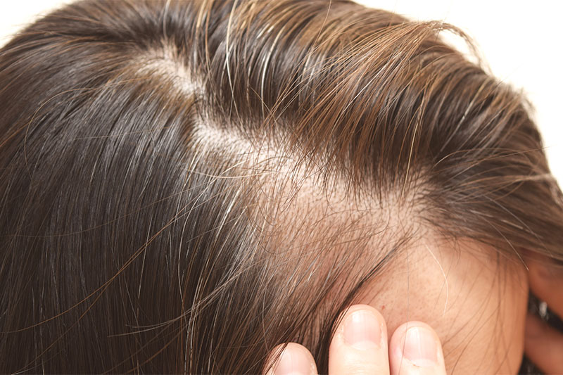 Something That You Eat Could Be To Blame For Thinning Hair
