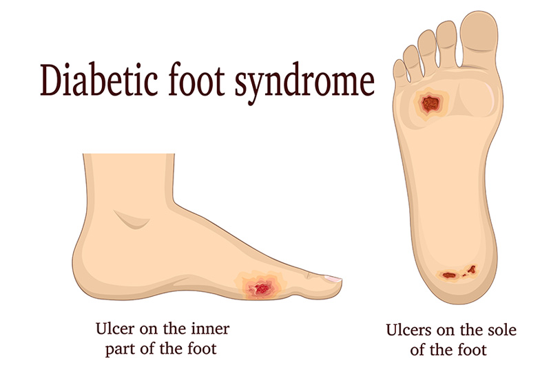 Ulcers on Your Feet that Do Not Heal