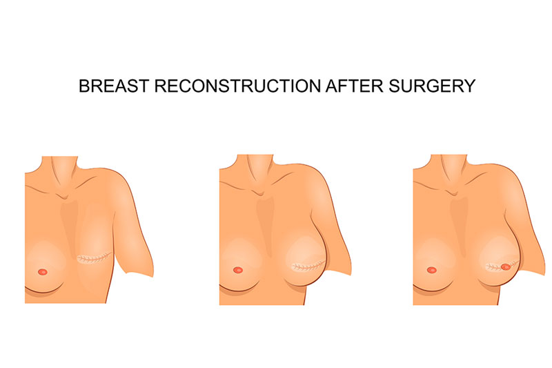 reconstruction Boob Job 