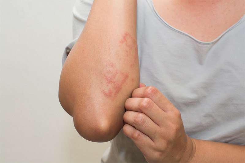 Heals Bites And Rashes rash skin