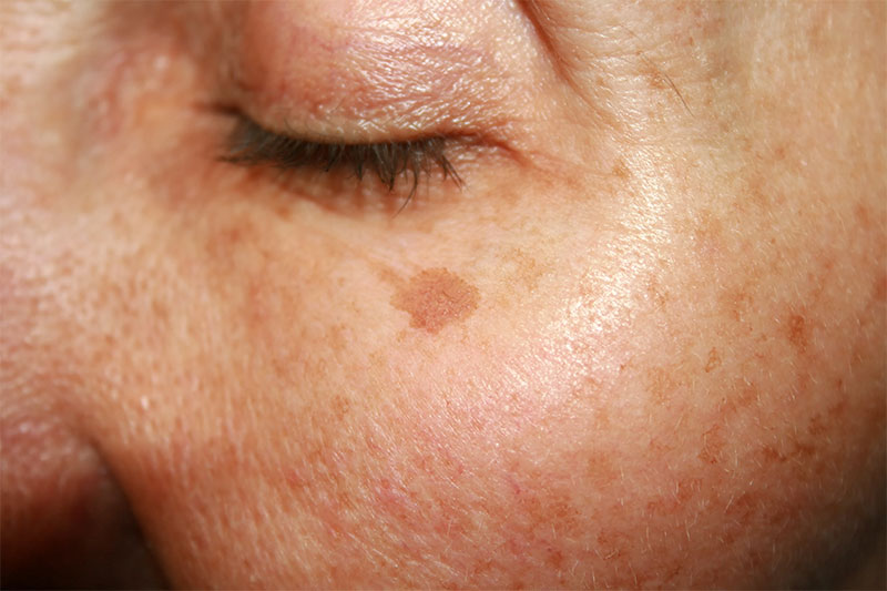 Age Spots skin