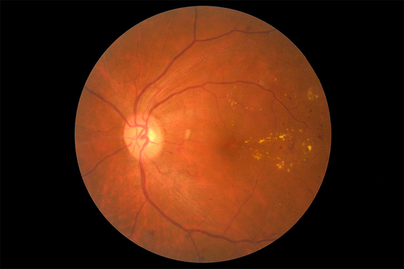 Retnal image of right eye in the patient with Diabetes mellitus, moderate non-proliferative diabetic retinopathy (NPDR) and Diabetic Macular Edema (DME).