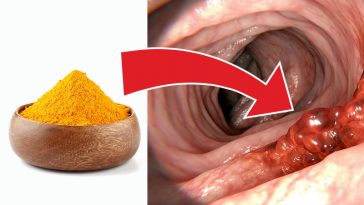 Fight Colon Cancer By Eating These 5 Tasty Spices!