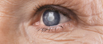 7 Silent Signs of Cataract You May Be Facing Without Knowing It