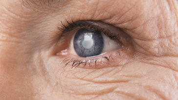 7 Silent Signs of Cataract You May Be Facing Without Knowing It