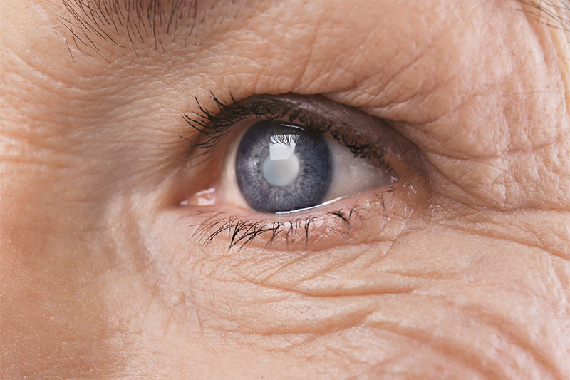 7 Silent Signs of Cataract You May Be Facing Without Knowing It