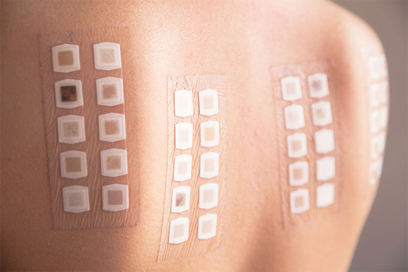 It Is Easy To Test For Skin Allergies