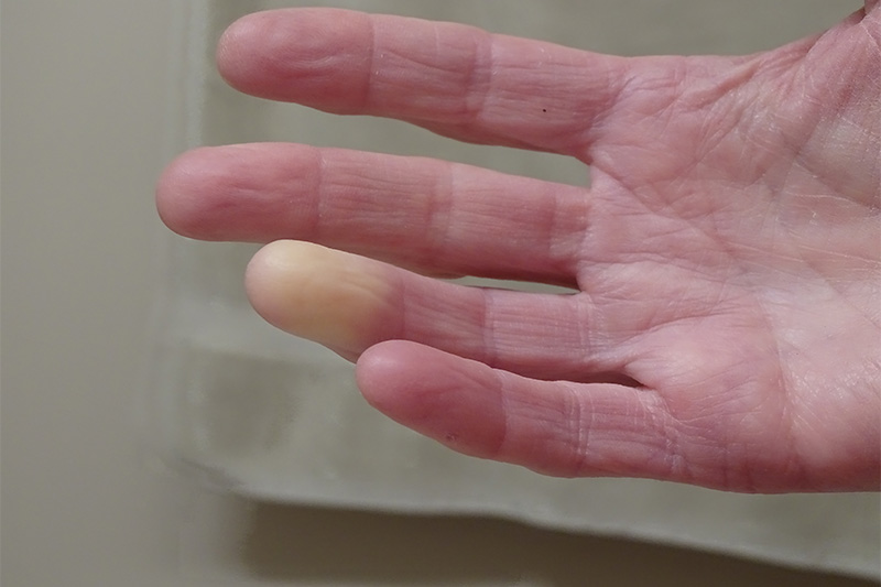 Raynaud's Syndrome