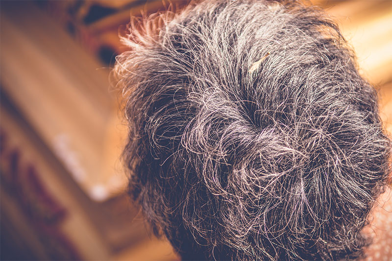 Understanding the Science of Gray/White Hair