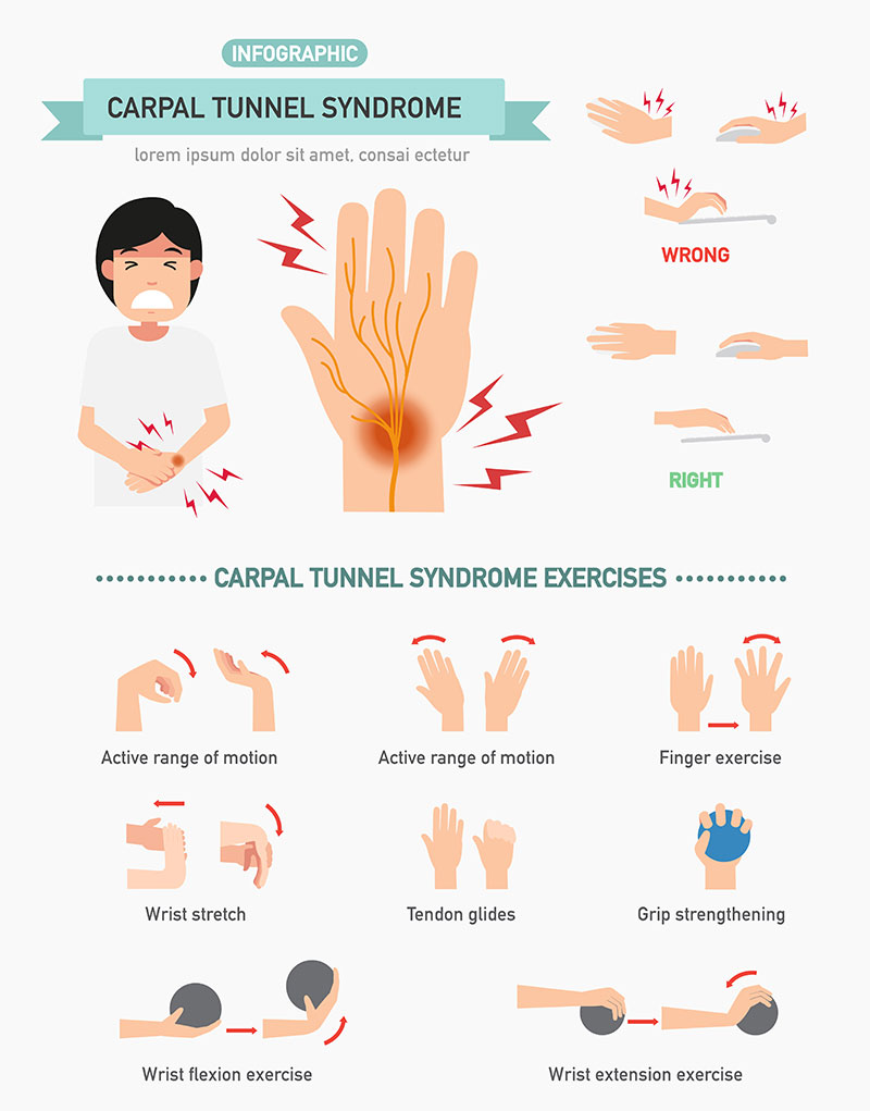 Carpal Tunnel Syndrome