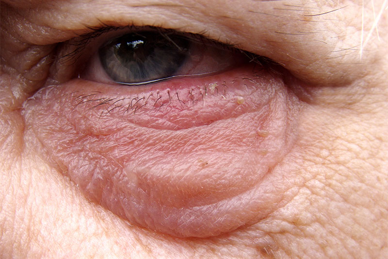 Eyelid Bumps