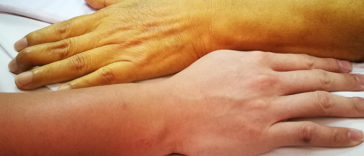 Orange Skin