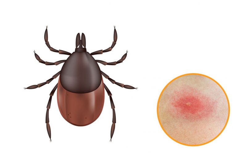 12 Bug Bites Anyone Should Be Able To Identify Factspedia 12 Bug Bites Anyone Should Be Able To Identify Factspedia