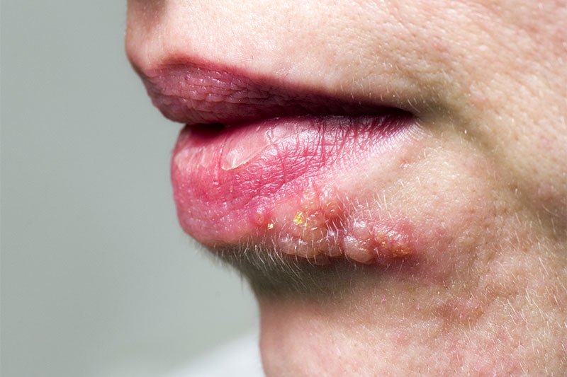 Examining The Possibility Of Herpes