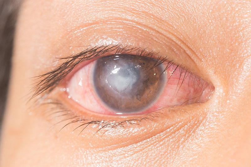 Corneal Ulcer eye