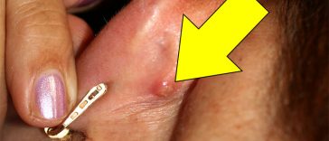 Do You Sometimes Have A Strange Little Bump Behind Your Ear? THIS Is What It Means!