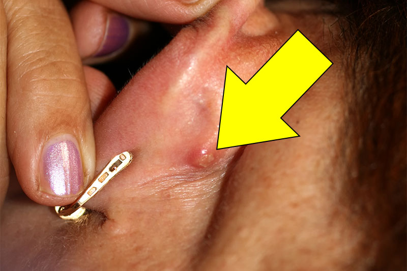 Do You Sometimes Have A Strange Little Bump Behind Your Ear? THIS Is What It Means!