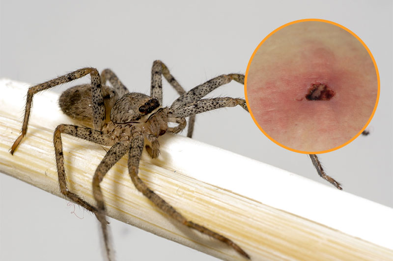 Brown Recluse Spider Bites Look Like Bruising