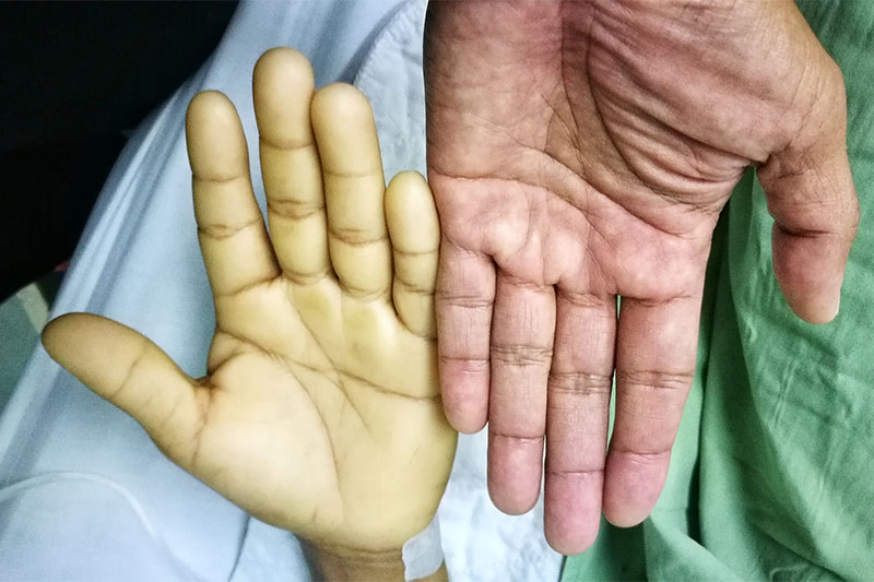 Anemia pale hands