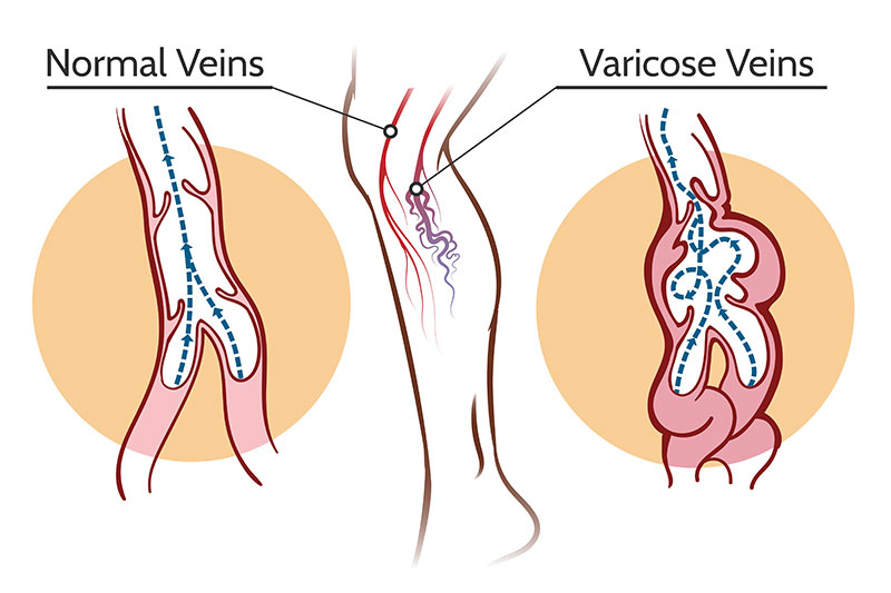 Varicose Veins surgery