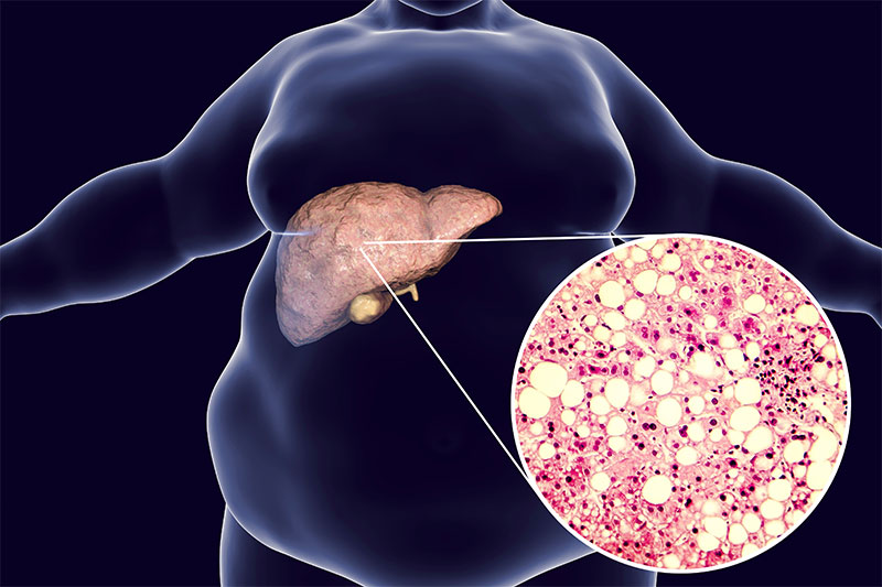 Fatty Liver