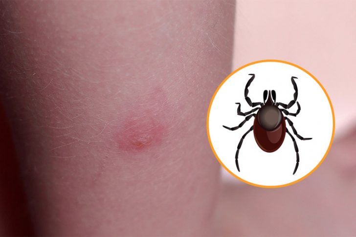 12 Bug Bites Anyone Should Be Able To Identify Factspedia 12 Bug Bites Anyone Should Be Able To Identify Factspedia