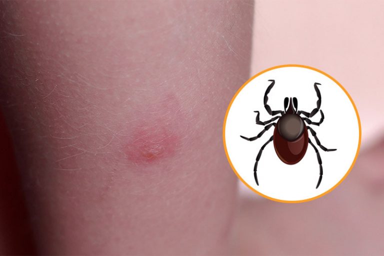 why-do-mosquito-bites-itch-wonderopolis