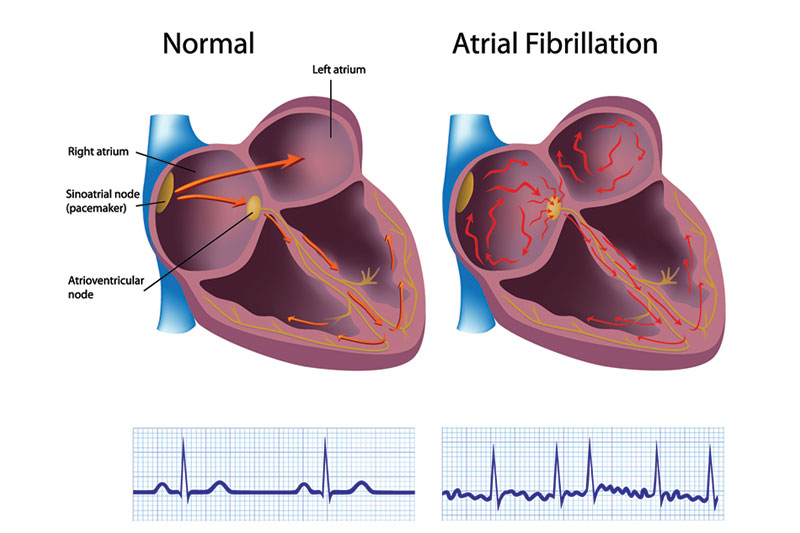 You Have An Atrial Fibrillation That Has Not Been Treated
